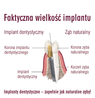 Wielkość implantu zęba