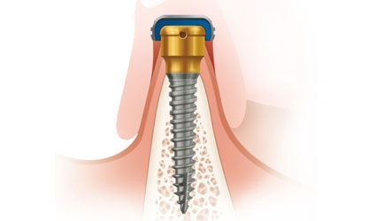 Nowość! Wąskie implanty (2,4 mm) do protez